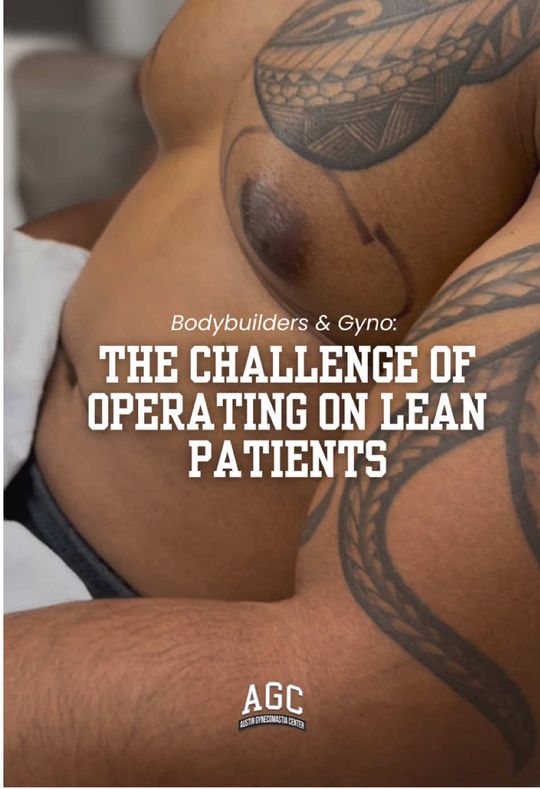 Video by Dr. Robert Caridi: Come behind the scenes with us ✨ Hear why Dr. C says bodybuilding gynecomastia cases are often th…