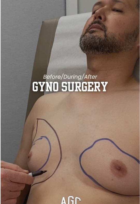 Video by Dr. Robert Caridi: Gynecomastia surgery is a process- not an overnight transformation. Swelling, scar tissue, and he…