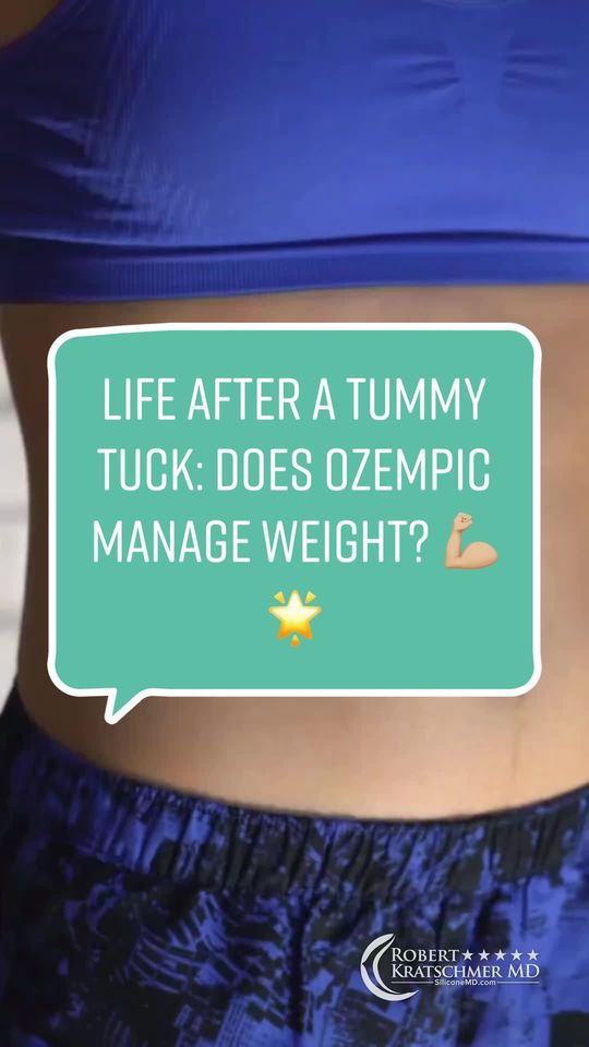 Video by Dr. Robert Kratschmer: Post-tummy tuck and wondering how to maintain your new shape? Dr. Robert Kratschmer shares the be…