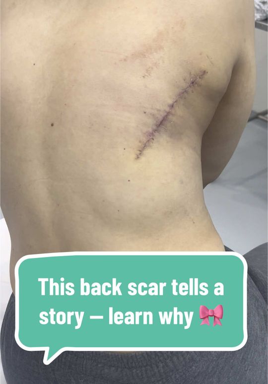Video by Dr. Robert Kratschmer: 2.5 weeks post-op from a latissimus dorsi flap reconstruction after mastectomy for breast cancer…