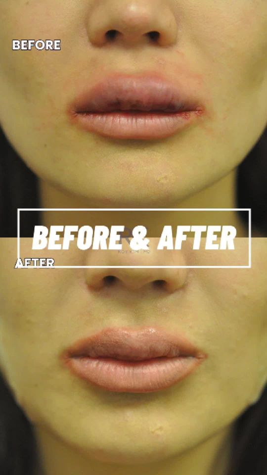 Video by Dr. Roy Kim: 💋 Before & After: Lip Filler Correction 💋 This patient had a previous lip filler deformity, whi…
