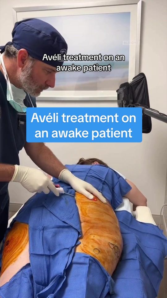 Video by Dr. S. Alexander Earle: Patient had a BBL but continued to have indentations due to cellulite so we did an Avéli Treatmen…
