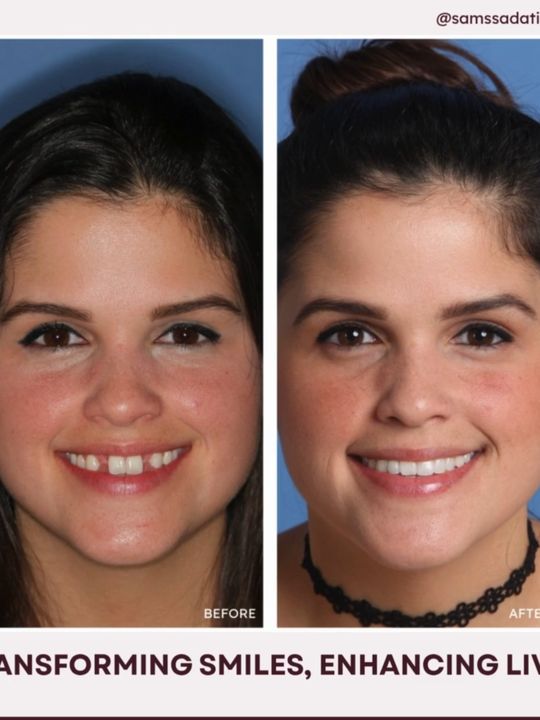 Video by Dr. Sam S. Sadati: She was born without her two lateral incisors — but you’d never know. With a carefully curated pl…