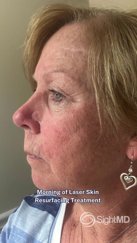 Video by Dr. Samuel Baharestani: One month. One treatment. Incredible results. 🌟 See the full 30-day journey with our Laser Skin…