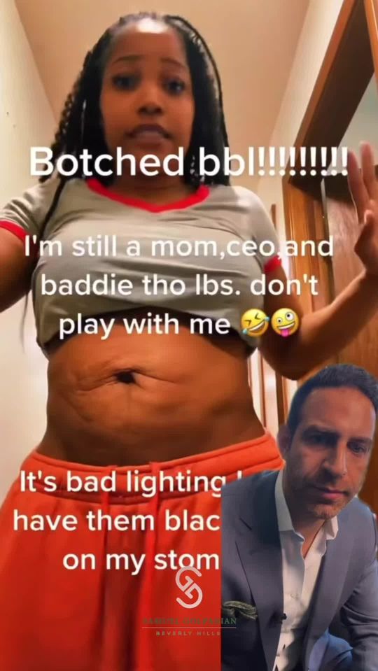 Video by Dr. Samuel Golpanian: Botched BBL: EXPLAINED! Unfortunately, contour irregularities can happen if you liposuction too a…