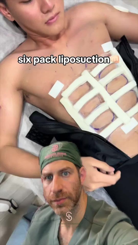 Video by Dr. Samuel Golpanian: a plastic surgeons thoughts on 6-pack lipo 🤨 Schedule a consultation with me! 📱 DM ME 📞 424.38…
