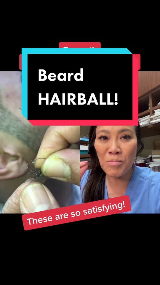 Video by Dr. Sandra Lee: with @kuaforekremkacar so you can see the satisfying part better.