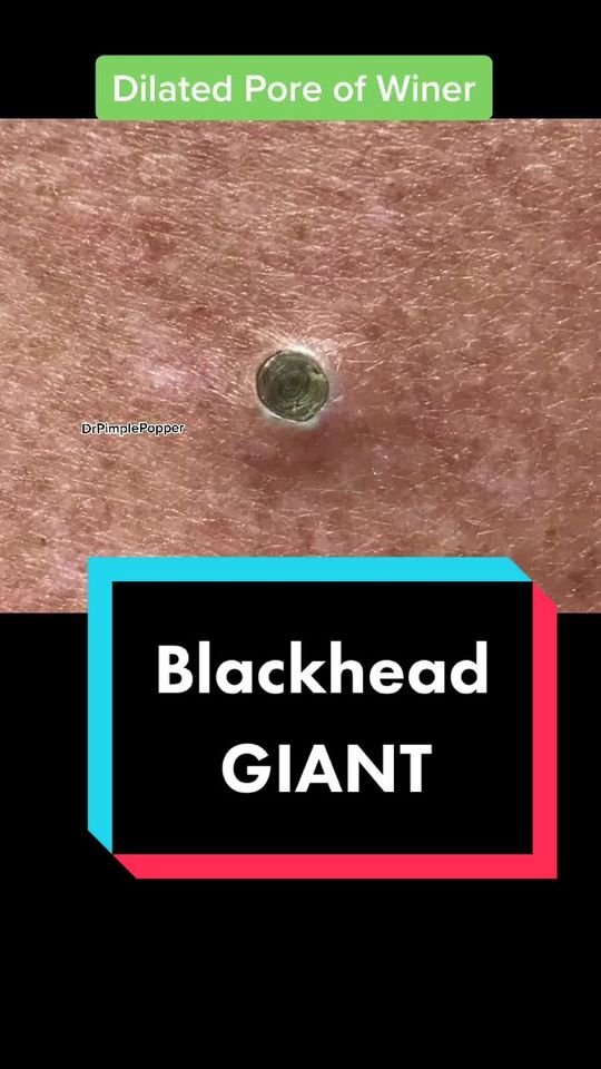 Video by Dr. Sandra Lee: Is your favorite the GIANT blackheads?