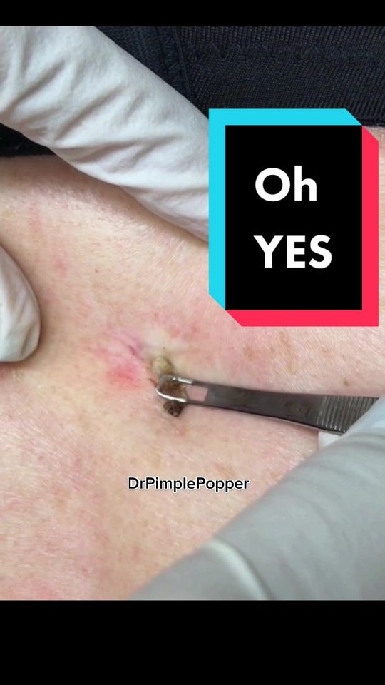 Video by Dr. Sandra Lee: Is it Oh No, or… Oh YES?! 🤔