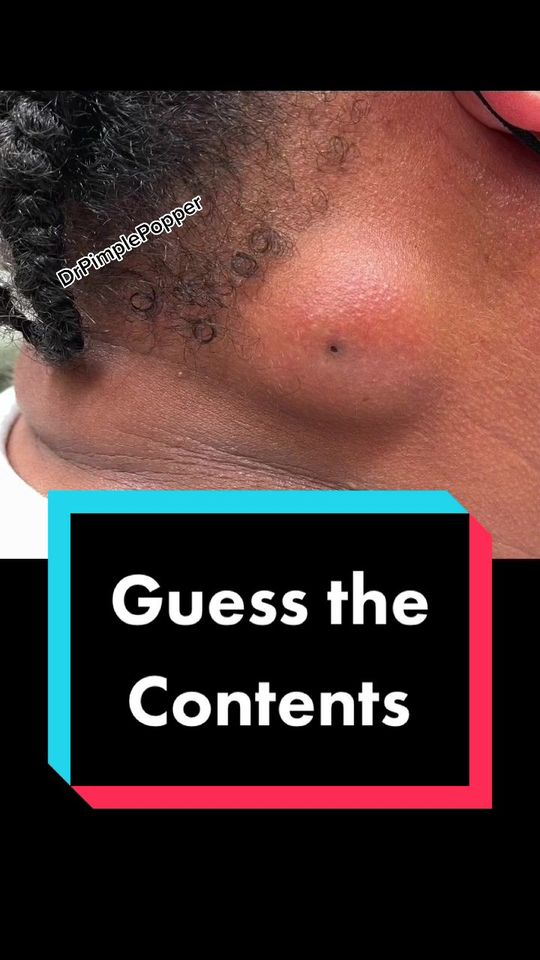 Video by Dr. Sandra Lee: Kristi my MA said it looks like ostmeal, what do you think?