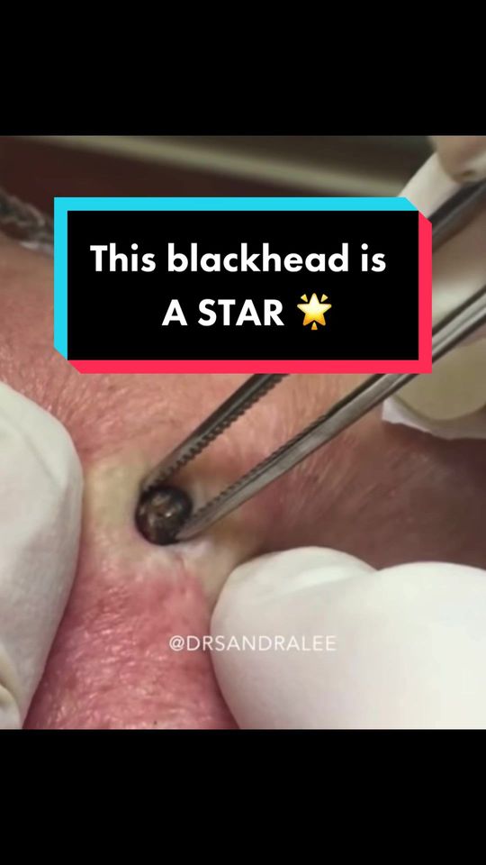 Video by Dr. Sandra Lee: POV: you’re my most popular blackhead on YouTube 😭😂 link in bio to watch!