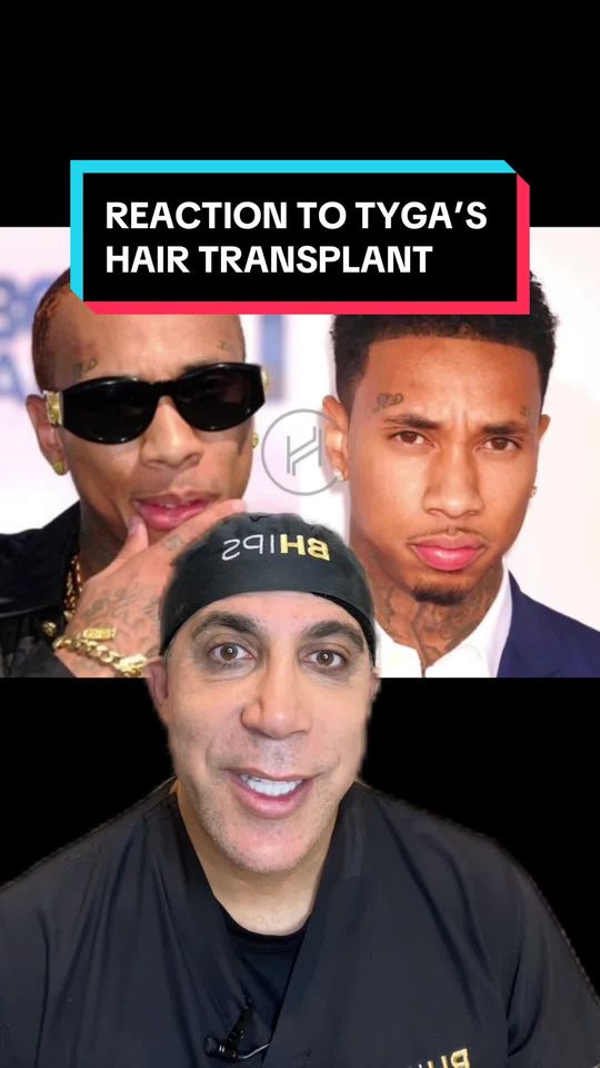 Video by Dr. Saul Lahijani: Plastic surgeon reacts to Tyga’s hair transplant