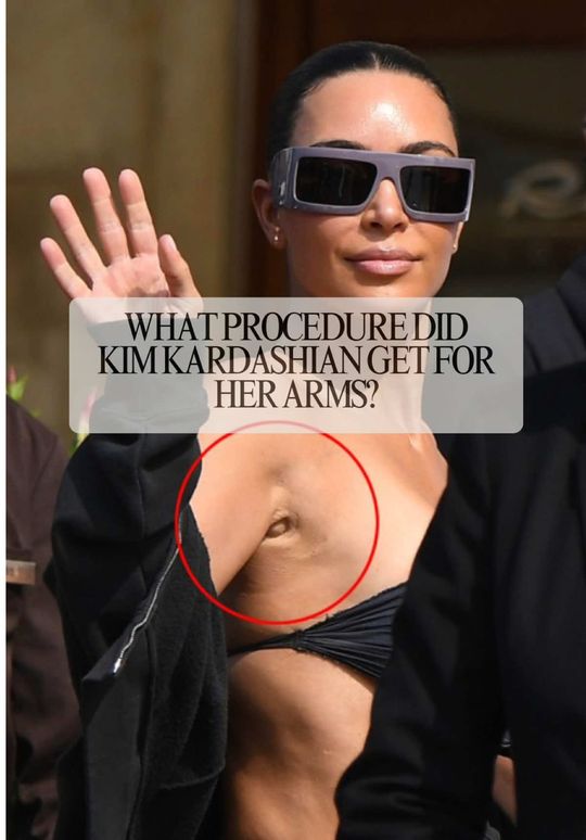 Video by Dr. Saul Lahijani: Breaking down the Kim K armpit speculation 👩‍⚕️ As a plastic surgeon, I’m seeing a lot of questi…