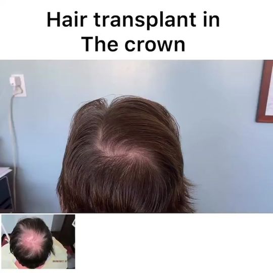 Video by Dr. Sean Behnam: Hair transplant in the crown area. Please notice how beautifully it is performed.
