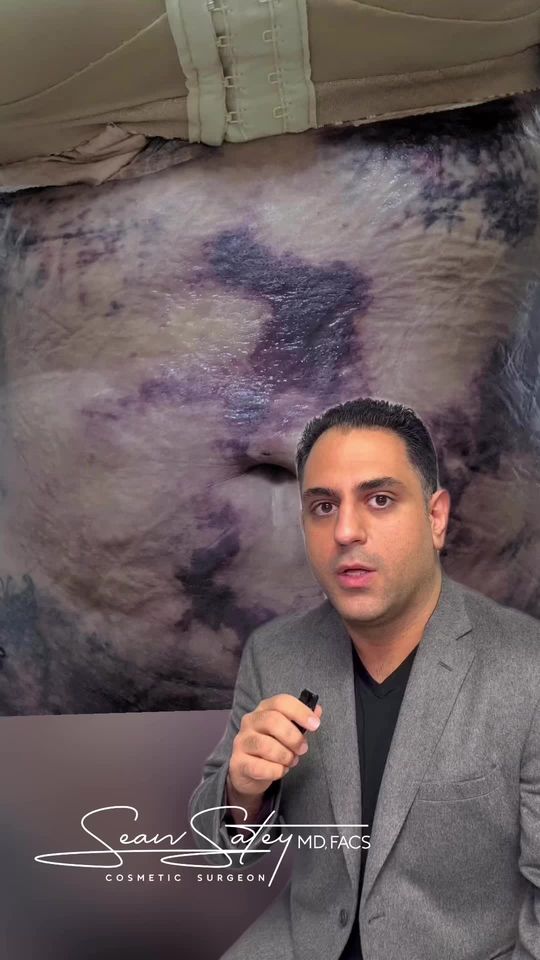 Video by Dr. Sean Satey: Understanding Liposuction Burn: While liposuction can yield incredible results, complications lik…