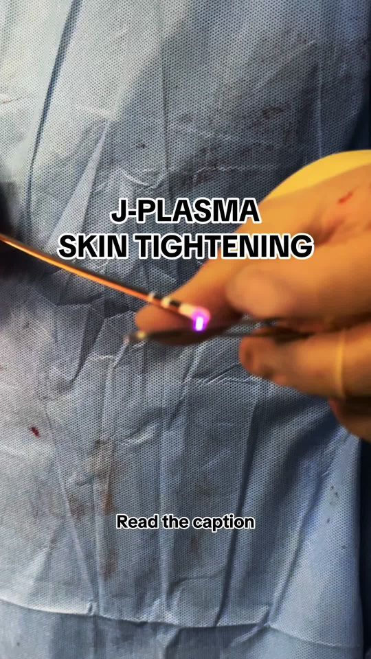 Video by Dr. Sean Satey: Harnessing the power of helium gas and radiofrequency energy, J-Plasma delivers controlled heat t…