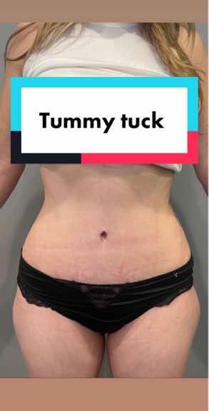 Video by Dr. Sejal M. Patel: Journey 22 I Tummy tuck at 3 months post op ♥️ Patient will continue to heal for up to 6 months a…