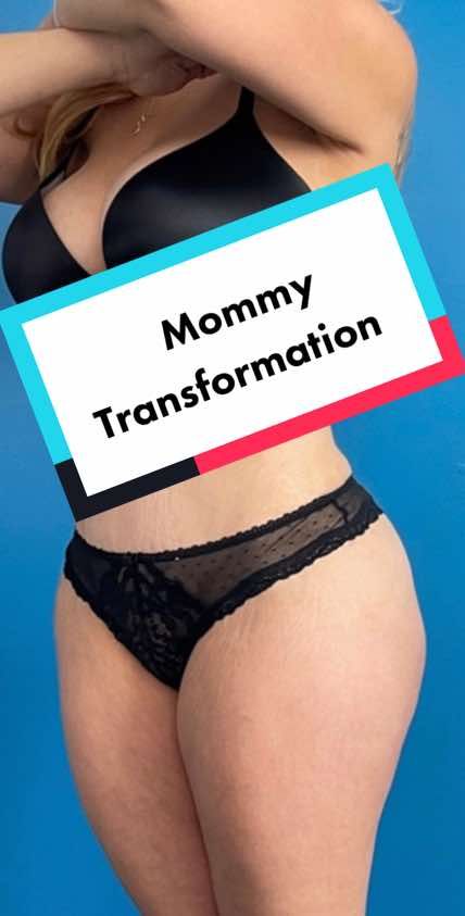 Video by Dr. Sejal M. Patel: Journey 14 I This patient underwent a Tummy Tuck procedure to tighten her muscles and remove the…