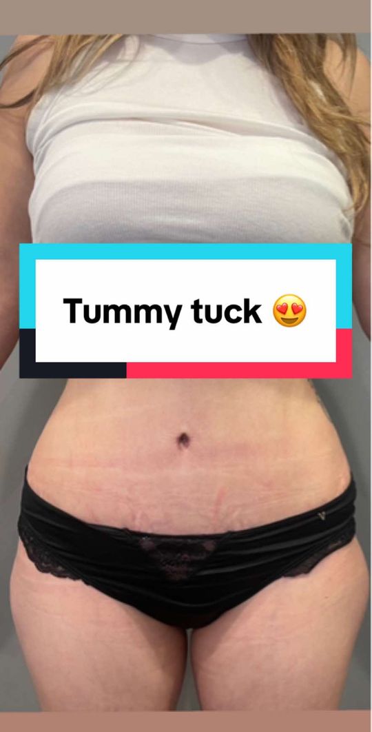 Video by Dr. Sejal M. Patel: Check out this beautiful result by 🌟 No Liposuction was performed. Patient is 3 months post op.…