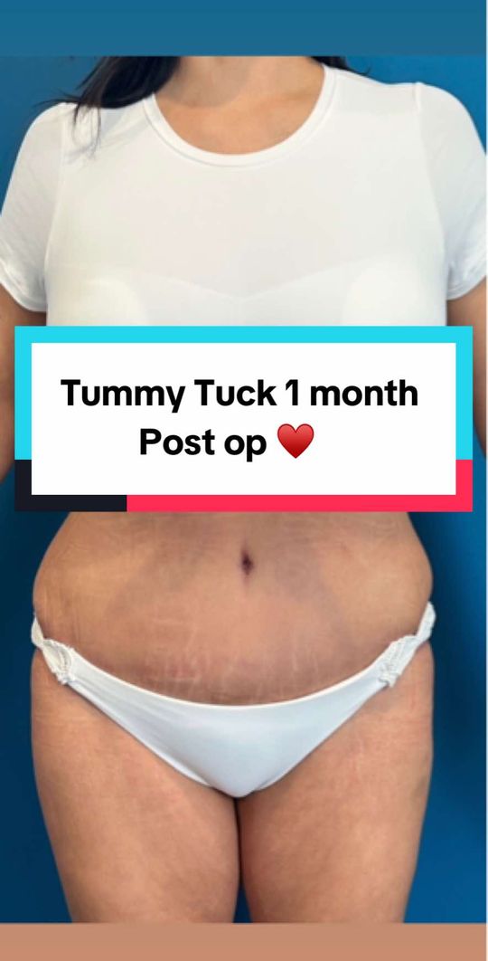 Video by Dr. Sejal M. Patel: Patient is 1 month post swelling will go down significantly for up to 6 months. No liposuction wa…