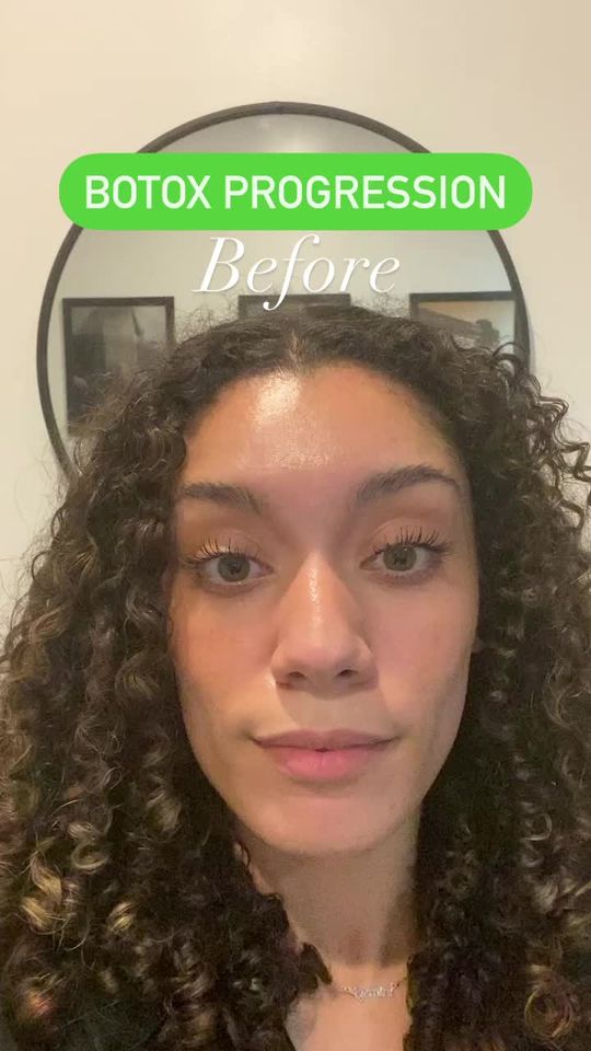 Video by Dr. Sherry Wehner: Botox results 3 wks after! 😍🤩 Call/txt (210) 405-5104 to book 💉
