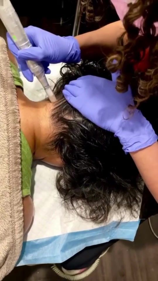 Video by Dr. Sherry Wehner: 👏FULL SCALP PRP TREATMENT!👏💆‍♀️ 🌟 Why Choose PRP Hair Restoration? 🌟 ✅ Natural Results: Say…