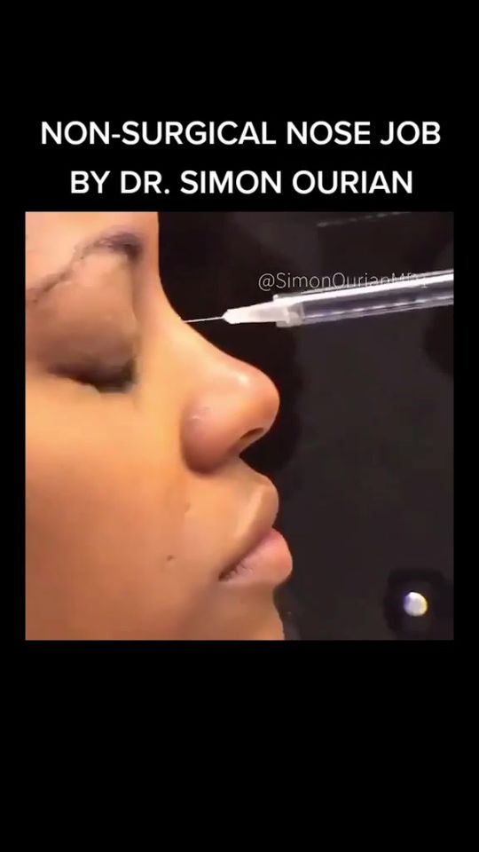 Video by Dr. Simon Ourian: Nonsurgical Nose Job by Simon Ourian, M.D.. Click on link in bio for a consultation.
