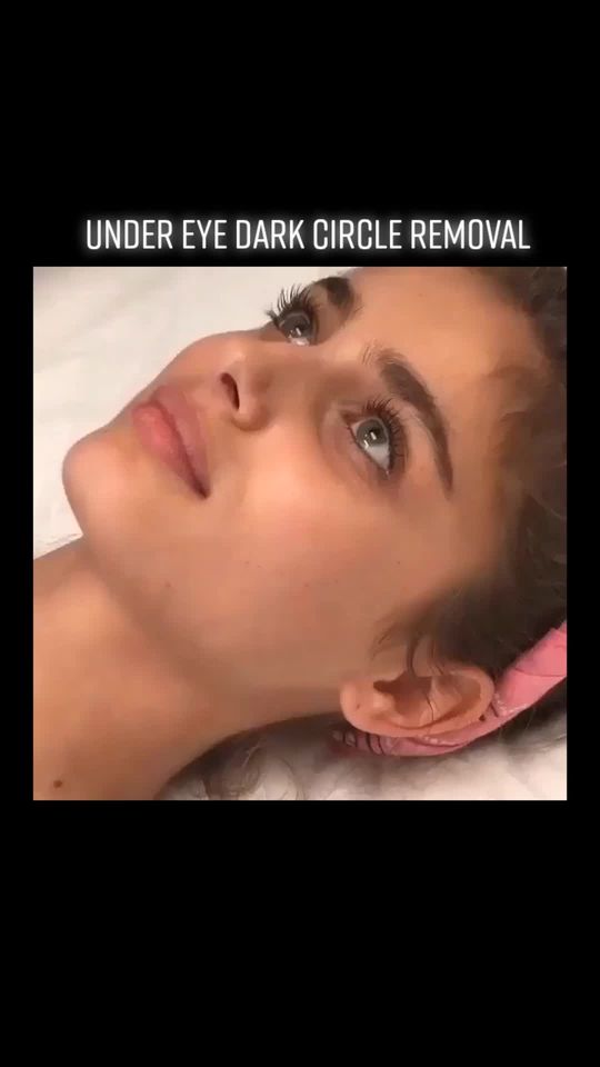 Video by Dr. Simon Ourian: Under eye dark circle removal by Dr. Simon Ourian. Click on link in bio for a consultation.