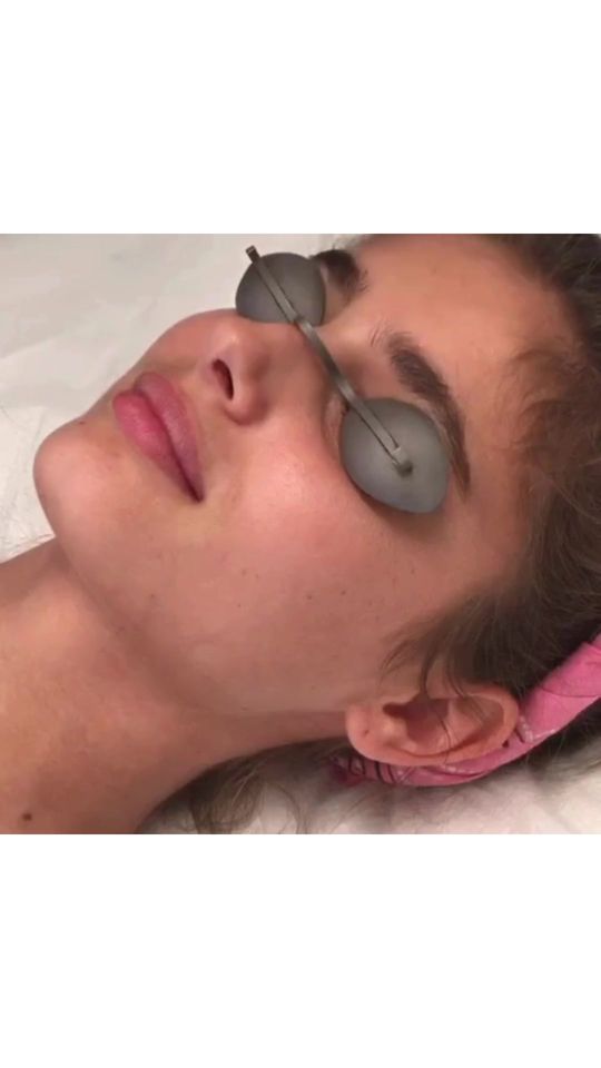 Video by Dr. Simon Ourian: Say goodbye to tired-looking eyes! Under-eye dark circles can make you look fatigued—even when yo…