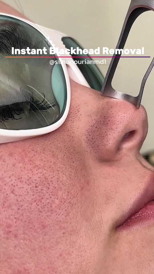 Video by Dr. Simon Ourian: Blackheads are among the most common concerns clients search for solutions to—yet the path to cla…