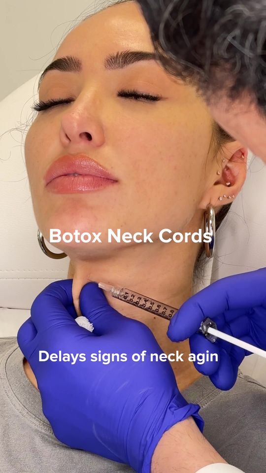 Video by Dr. Simon Ourian: Neck cords are one of the most visible signs of aging—and one of the most asked questions is, “Ca…