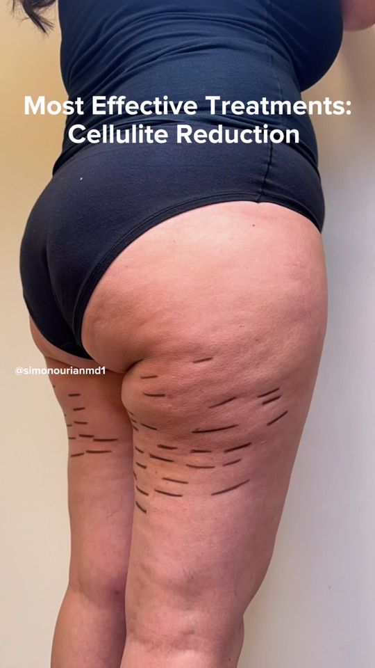 Video by Dr. Simon Ourian: Cellulite is one of the most common body concerns—and yes, it can be treated. Dr. Simon Ourian of…