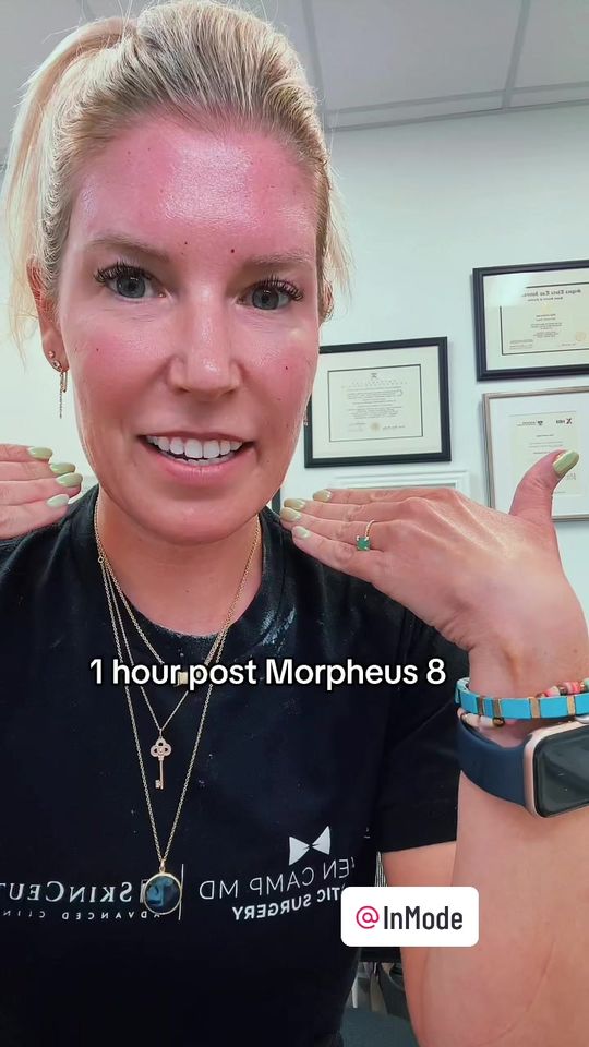 Video by Dr. Steven M. Camp: I am 1 hour post and feeling excited about tight skin, smaller pores and good texture. Click on o…