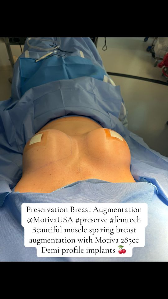 Video by Dr. Steven M. Camp: The future of breast augmentation is here with preservation breast augmentation using advaced tec…