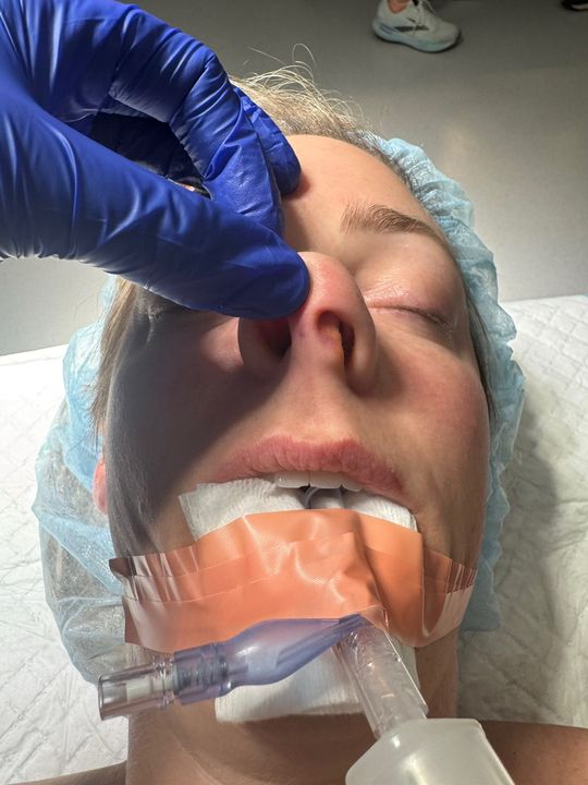 Video by Dr. Steven M. Camp: 🩺 Medical procedures: Rhinoplasty to correct a crooked nose and deviated septum. 🛌 Patient comf…