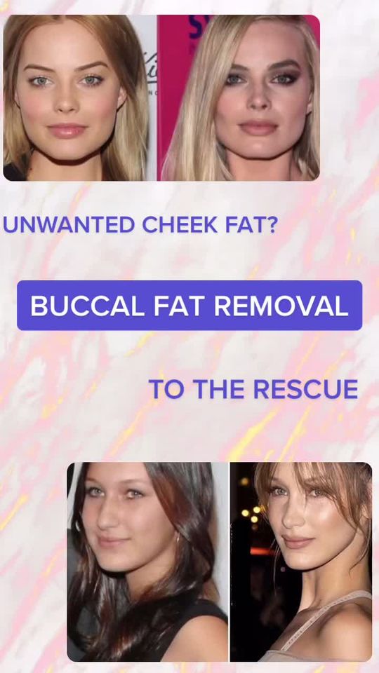 Video by Dr. Steven Svehlak: Unwanted cheek fat? BUCCAL FAT REMOVAL to the rescue 🪄