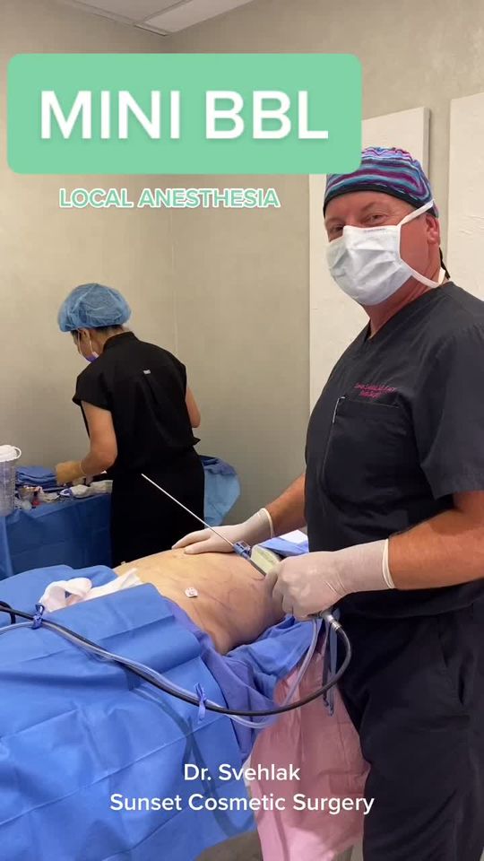 Video by Dr. Steven Svehlak: MINI BBL by Dr. Svehlak, Sunset Cosmetic Surgery