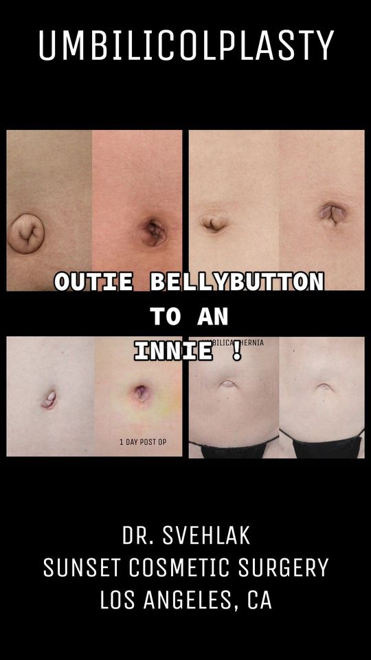 Video by Dr. Steven Svehlak: UMBILICOLPLASTY BEFORE & AFTER. Turning an outie to an innie in 1-2 hours under a local anesthesi…