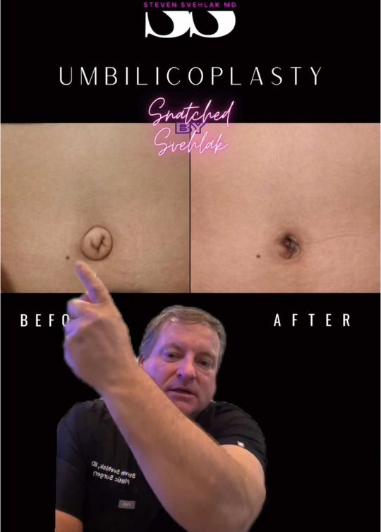 Video by Dr. Steven Svehlak: Bellybutton turned innie