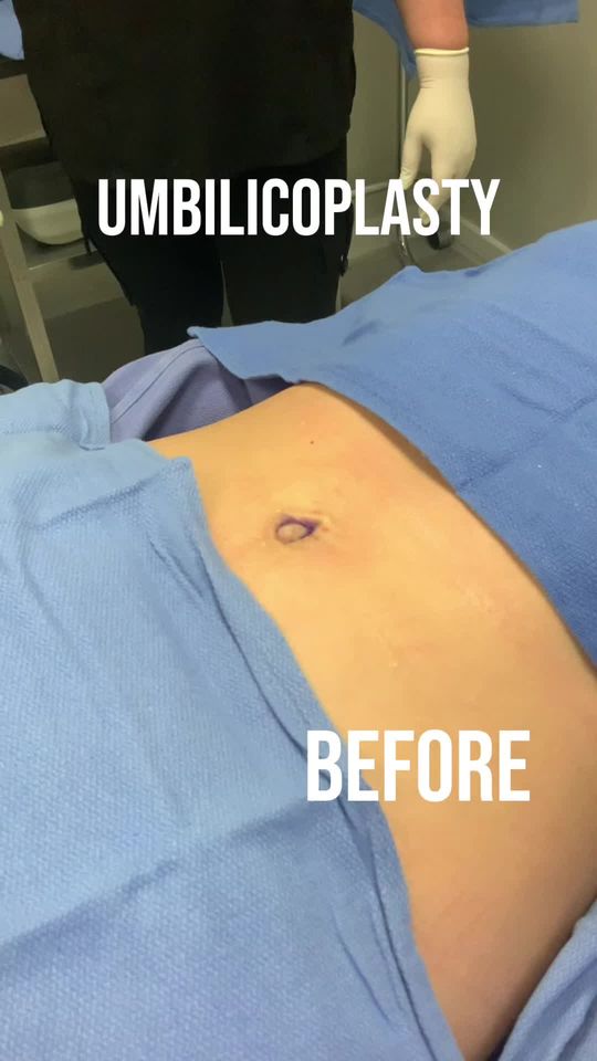 Video by Dr. Steven Svehlak: Outtie Bellybutton turned Innie with a quick in office procedure 💉✨ SNATCHED by SVEHLAK 🪄 To bo…
