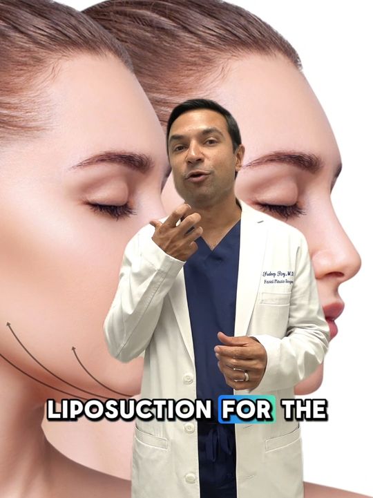 Video by Dr. Steven Swengel: @drroylosgatos talks about liposuction in the neck and things to be cautious about