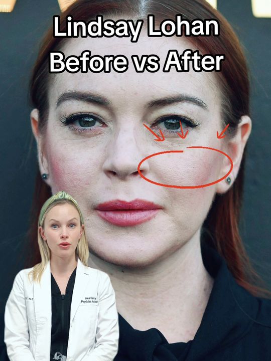 Video by Dr. Steven Swengel: We love seeing Lindsay Lohan's transformation and wanted to share with you what we think some of…