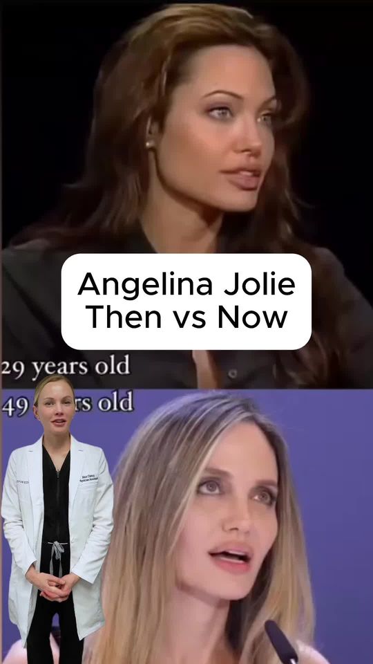 Video by Dr. Steven Swengel: Loving Angelina Jolie's before and after results and our PA Alex breaks down how she has maintain…