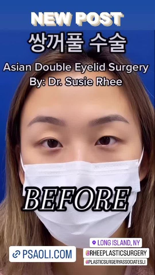 Video by Dr. Susie Rhee: ✨Asian Double Eyelid Surgery✨ Dr. Susie Rhee specializes is eyelid surgeries as well as Asian dou…