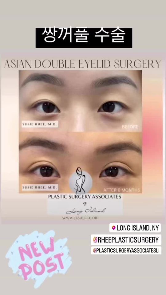 Video by Dr. Susie Rhee: ✨Asian Double Eyelid Surgery✨ Dr. Susie Rhee specializes is eyelid surgeries as well as Asian dou…