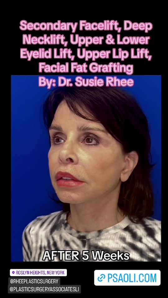 Video by Dr. Susie Rhee: 🤩 Transformative Full Face & Neck Rejuvenation: This sweet and vivacious patient was dissatisfie…