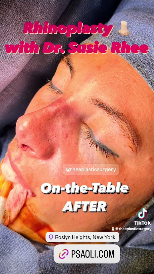 Video by Dr. Susie Rhee: 🤩👃🏻Transformation Case - Rhinoplasty by Long Island based, board-certified plastic surgeon, Dr…