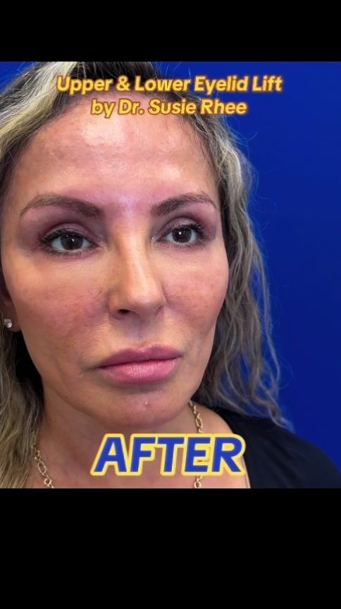 Video by Dr. Susie Rhee: 🔥🔥🔥 Upper & Lower Eyelid Lift (Upper Blepharoplasty, Lower Blepharoplasty with Skin Pinch). Th…