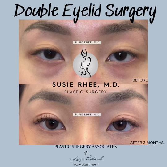 Video by Dr. Susie Rhee: ✨Asian Double Eyelid Surgery✨ Dr. Susie Rhee specializes is eyelid surgeries as well as Asian dou…