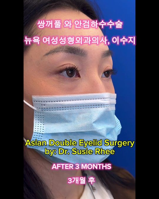 Video by Dr. Susie Rhee: ✨Asian Double Eyelid Surgery✨ Dr. Susie Rhee specializes is eyelid surgeries as well as Asian dou…